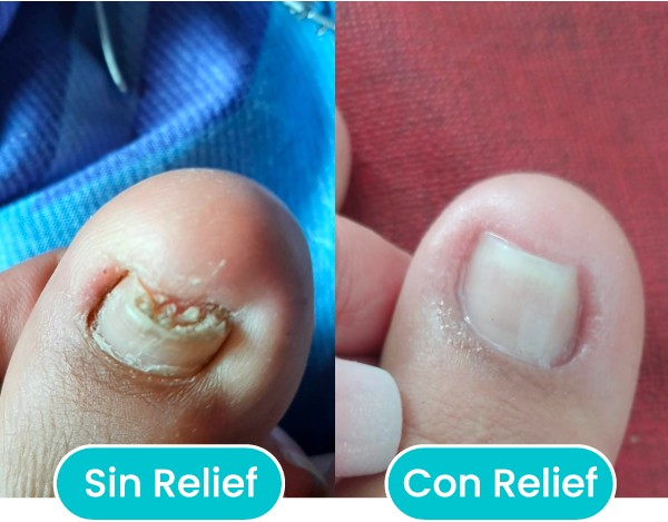 Testimonios de uñas y pies