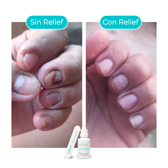 UÑAS SANAS: GOTAS PARA ELIMINAR HONGOS EN LAS UÑAS