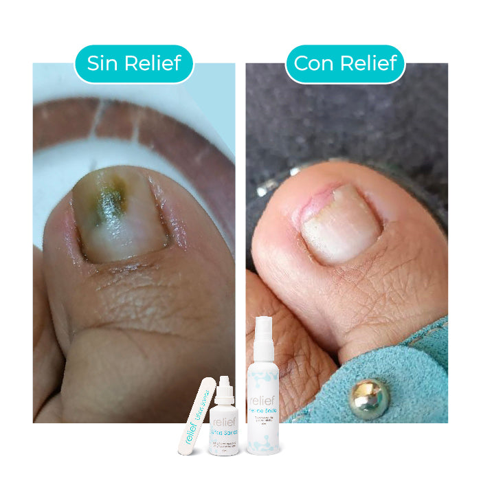 UÑAS SANAS: GOTAS PARA ELIMINAR HONGOS EN LAS UÑAS