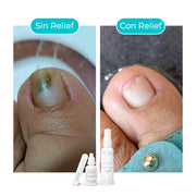COMBO UÑAS Y PIES: Tratamiento para la Onicomicosis
