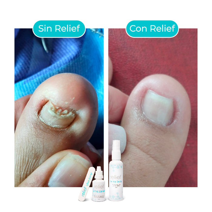 COMBO UÑAS Y PIES: Tratamiento para la Onicomicosis