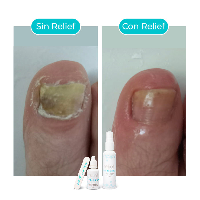 COMBO UÑAS Y PIES: Tratamiento para la Onicomicosis