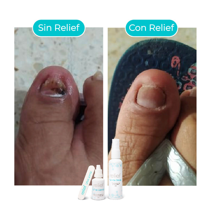 UÑAS SANAS: GOTAS PARA ELIMINAR HONGOS EN LAS UÑAS