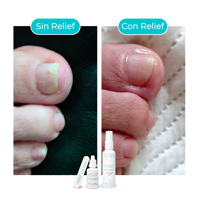 COMBO UÑAS Y PIES: Tratamiento para la Onicomicosis